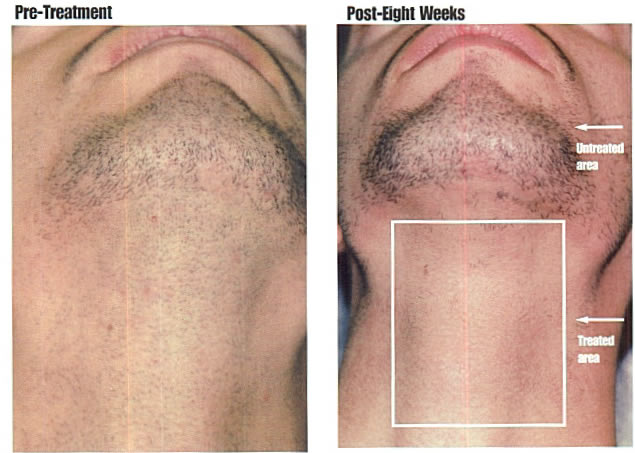 Understanding What Is Laser Hair Removal And How It Can Help You