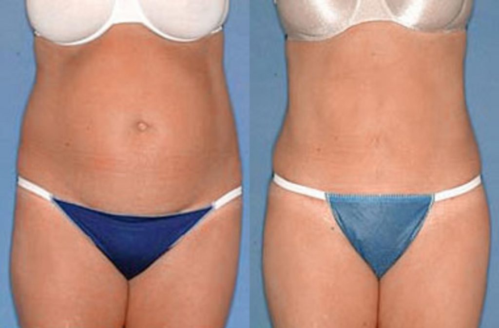 5 Things You Need To Know About Tummy Tuck Recovery